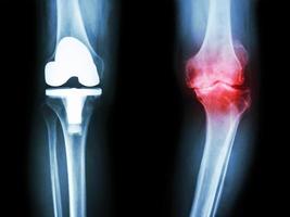 Radiografía de película de rodilla de paciente de rodilla con osteoartritis y articulación artificial foto