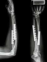 Fracture shaft of radius and ulnar bone. It was operated and internal fixed by plate and screw photo