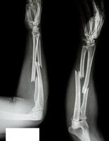 Fracture shaft of radius and ulnar bone photo