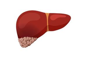 Unhealthy liver cancer. Human exocrine gland organ tumor destruction concept. Vector oncology flat illustration