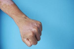 Burns on man's hand on blue background photo