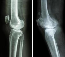 rodilla normal y rodilla con osteoartritis foto