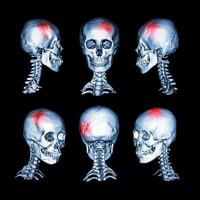 CT scan and 3D image of head and cervical spine photo