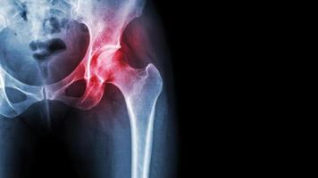 Arthritis at hip joint photo