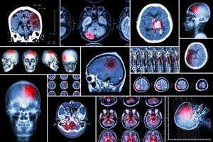 Set collection of brain diseases