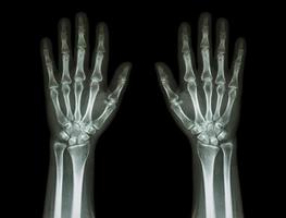 X-Ray hands, front view photo