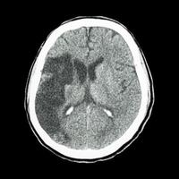 ct cerebro mostrar accidente cerebrovascular isquémico foto