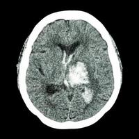 Tc cerebro muestra hemorragia talámica izquierda foto