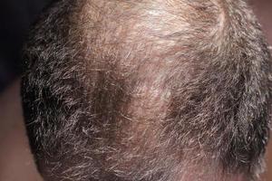 Hair loss, man scalp, baldness closeup photo