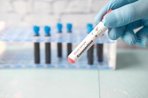 hand in blue medical gloves holding blood test tube photo