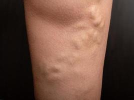 leg with varicose veins closeup photo