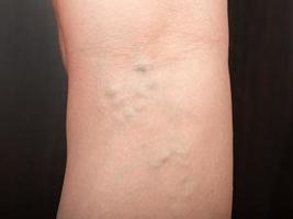 phlebeurysm, varicose veins of the lower extremities close-up, peripheral vascular disease photo