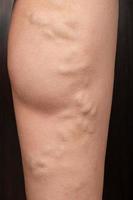 phlebeurysm, varicose veins of the lower extremities close-up, peripheral vascular disease photo