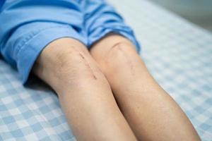 paciente asiático mayor o anciana mujer muestra sus cicatrices quirúrgico reemplazo total de la articulación de la rodilla sutura herida cirugía artroplastia en la cama en la sala del hospital de enfermería, concepto médico fuerte y saludable. foto