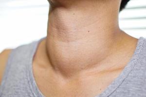 asiático tiene tiroides en el cuello foto