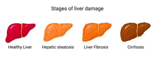 Stages of liver damage. vector