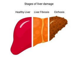 Stage of liver damage. vector