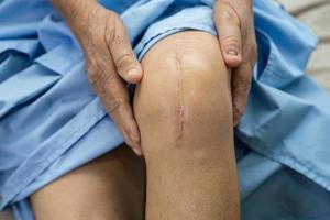 Paciente mayor asiático de Omán mostrar sus cicatrices quirúrgicas de rodilla total