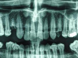 radiografía de dientes humanos foto