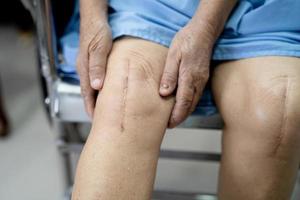 Paciente mayor asiático muestra sus cicatrices quirúrgico reemplazo total de rodilla