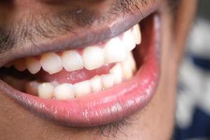 young man open mount checking his teeth photo