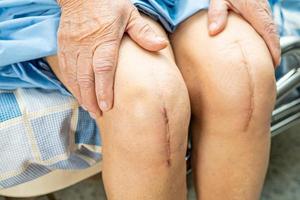 Paciente mujer senior asiática mostrar sus cicatrices quirúrgicas de rodilla total foto