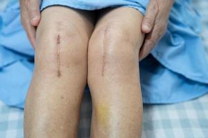 Paciente mujer senior asiática mostrar sus cicatrices quirúrgicas de rodilla total foto
