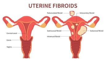 Diagrama de fibromas uterinos de la mujer sobre fondo blanco. vector