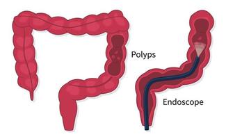 Flat vector of colorectal cancer polyps screening