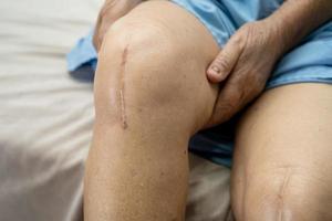 Paciente mujer mayor asiática mostrar sus cicatrices quirúrgico articulación total de la rodilla foto