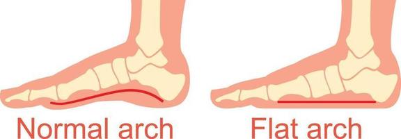 Normal and Flat Arch vector