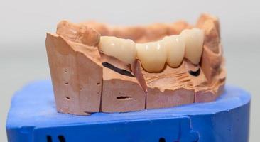 Zirconium Porcelain Tooth plate in Dentist Store photo