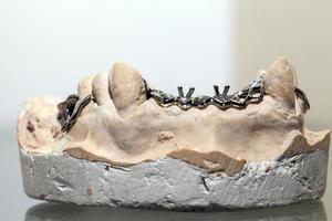 Placa dental de porcelana de circonio en la tienda del dentista foto