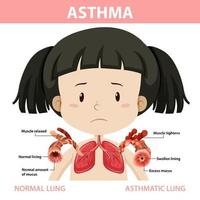 diagrama de asma con pulmón normal y pulmón asmático vector