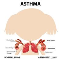 diagrama de asma con pulmón normal y pulmón asmático vector