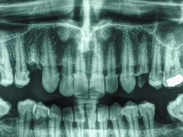 radiografía de dientes humanos foto