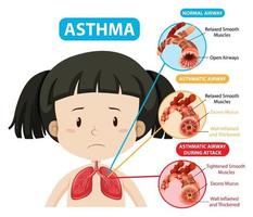 Asthma diagram with normal airway and asthmatic airway vector