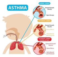 Asthma diagram with normal airway and asthmatic airway vector