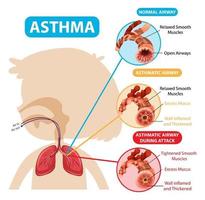 Asthma diagram with normal airway and asthmatic airway vector