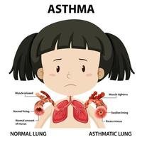 diagrama de asma con pulmón normal y pulmón asmático vector