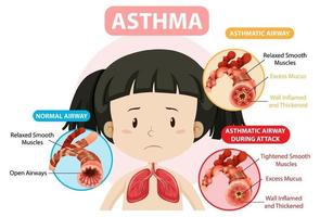 Asthma diagram with normal airway and asthmatic airway vector