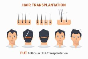 Stages of hair transplantation FUT Follicular Unit vector