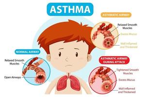 Asthma diagram with normal airway and asthmatic airway vector