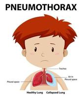 Pneumothorax diagram of human anatomy vector