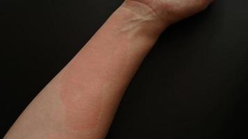 mano femenina cubierta de manchas rojas, primer plano. reacción alérgica foto