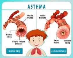 Asthma diagram with normal lung and asthmatic lung vector