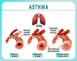 Bronchial Asthma diagram with normal airway and asthmatic airway vector