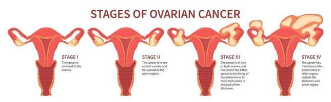 Cuatro etapas del cáncer de ovario blanco aislado vector