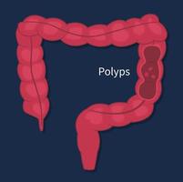 chequeo de pólipos de cáncer de colon endoscópico plano de vector