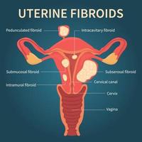 Uterine fibroids close-up view on dark blue vector